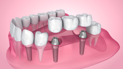 How a Dental Bridge Addresses a Missing Tooth